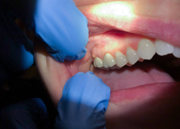 Best Emergency Treatment for Dental Infections or Abscesses in Buckingham, FL